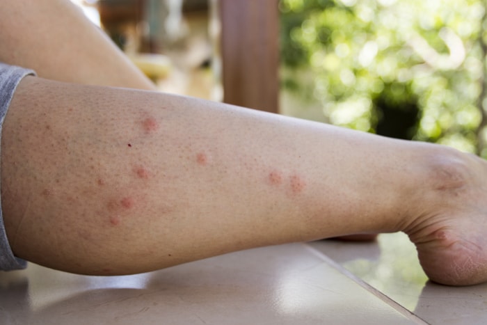 Piqûres de moustiques sur la jambe.